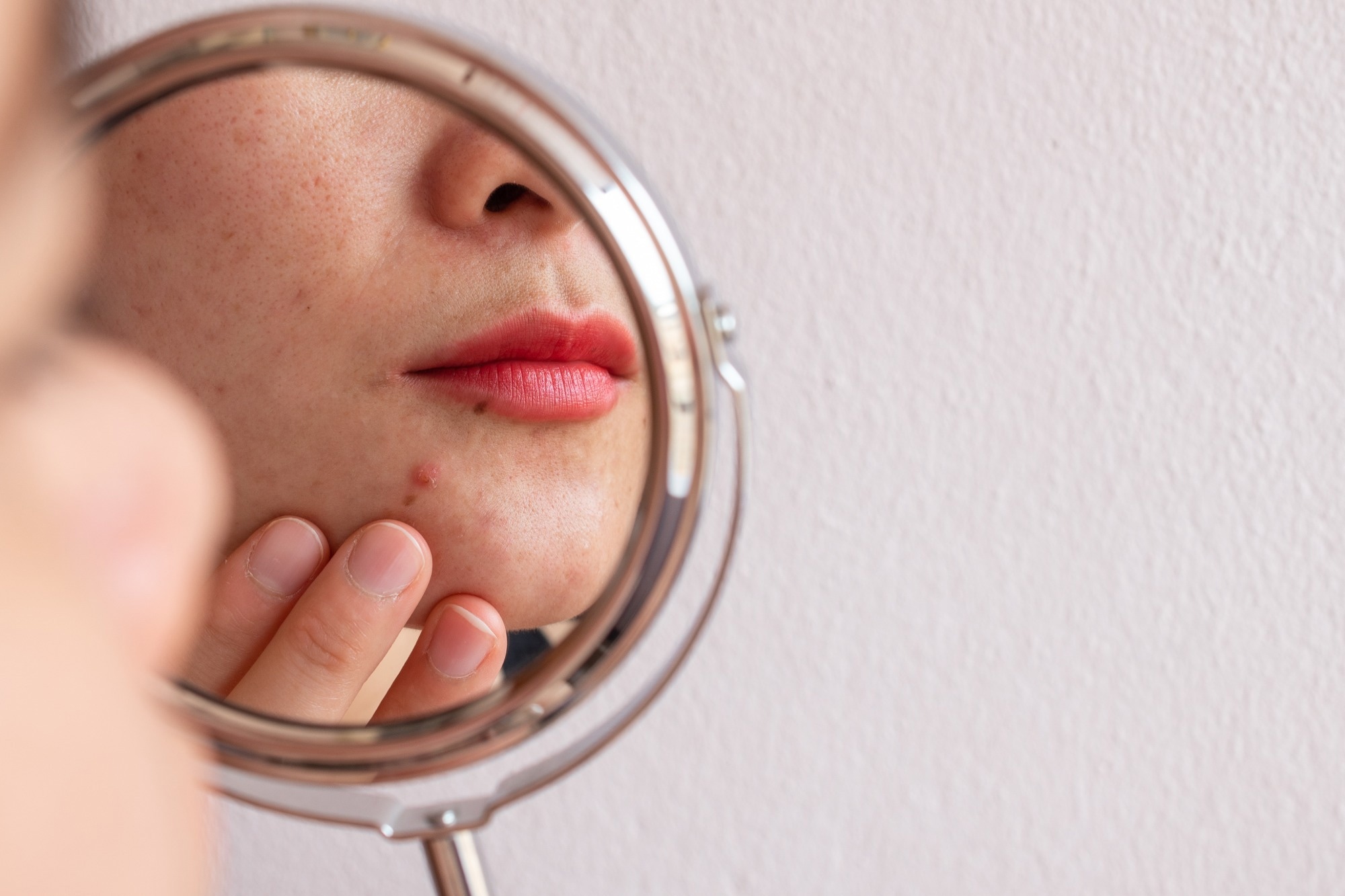 Study: Dietary Patterns in Acne and Rosacea Patients—A Controlled Study and Comprehensive Analysis. Image Credit: Boyloso/Shutterstock.com