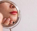 How does diet impact rosacea and acne?
