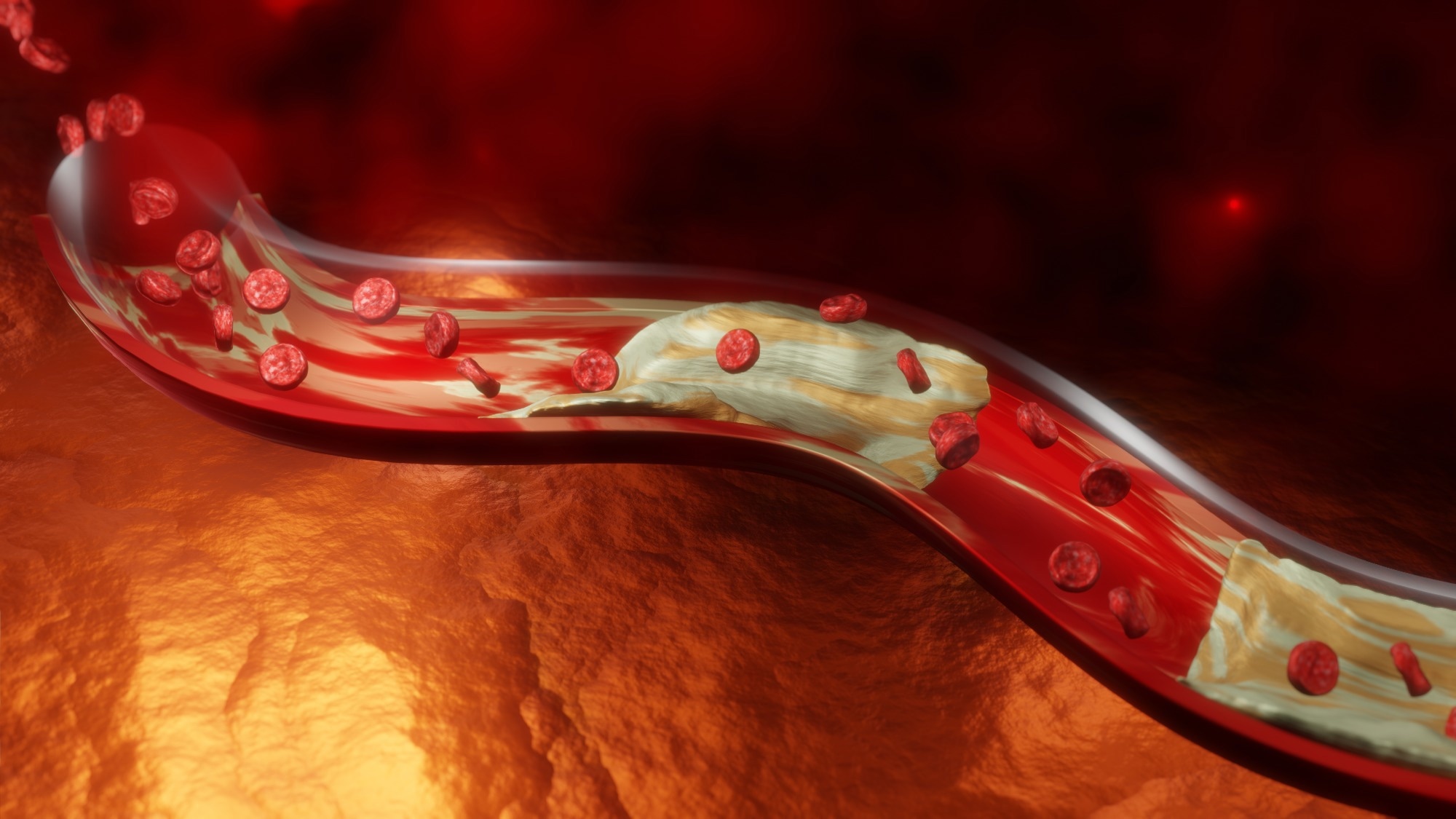 Study: Sex differences in risk factors for incident peripheral artery disease hospitalisation or death: Cohort study of UK Biobank participants. Image Credit: Anshuman Rath/Shutterstock.com