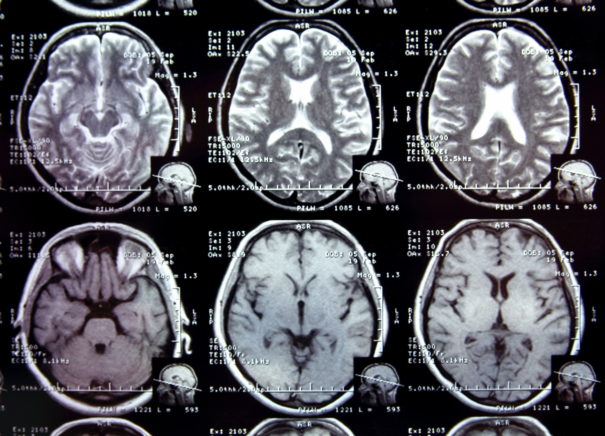 Does COVID-19 damage the brain? - Harvard Health