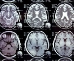 Is COVID-19 a risk factor for Alzheimer's disease?