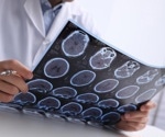 AI-based MRI tools show promise in multiple sclerosis diagnosis