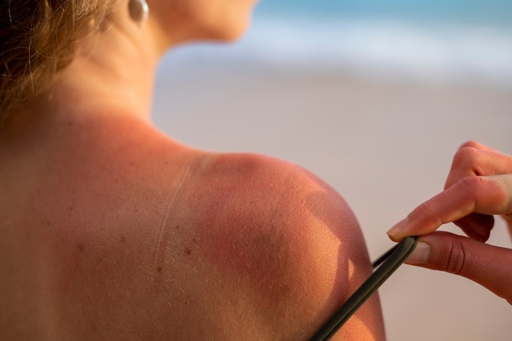 Study: Understanding the Perceived Relationship between Sun Exposure and Melanoma in Atlantic Canada: A Consensual Qualitative Study Highlighting a “Sunscreen Paradox”. Image Credit: james benjamin/Shutterstock.com