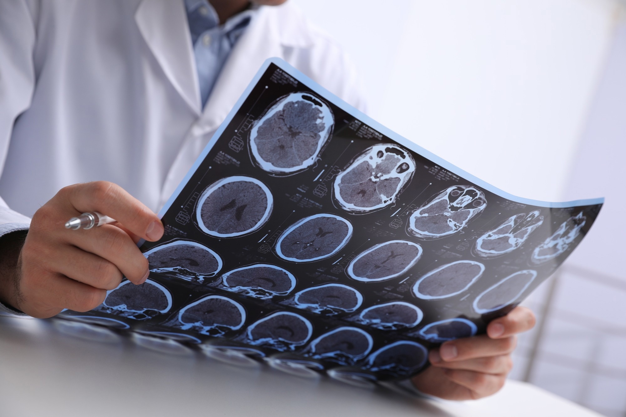 Study: Proteomics reveal biomarkers for diagnosis, disease activity and long-term disability outcomes in multiple sclerosis. Image Credit: New Africa/Shutterstock.com