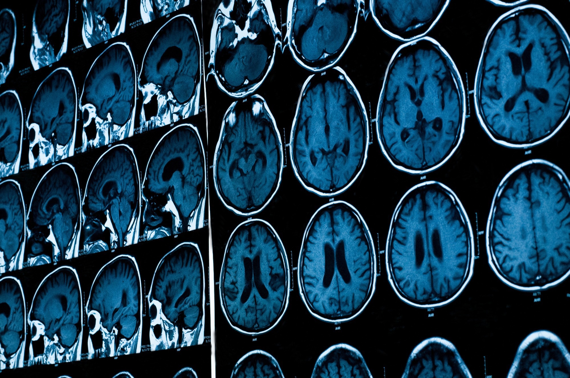 Study: Adverse Life Experiences and Brain Function: A Meta-Analysis of Functional Magnetic Resonance Imaging Findings. Image Credit: Tushchakorn / Shutterstock.com