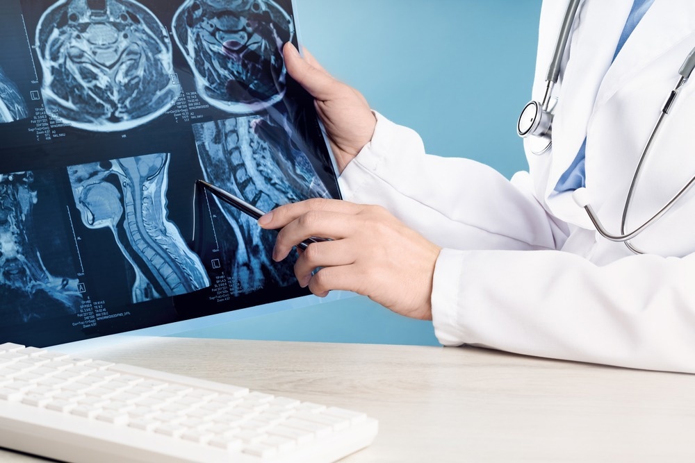 Study: A spinal cord neuroprosthesis for locomotor deficits due to Parkinson’s disease. Image Credit: taniascamera/Shutterstock.com