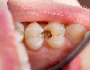 Fluoride and sealants win against youth dental caries, a robust review informs US health policy