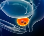 Multi-ancestry study reveals 187 new genetic risk factors for prostate cancer