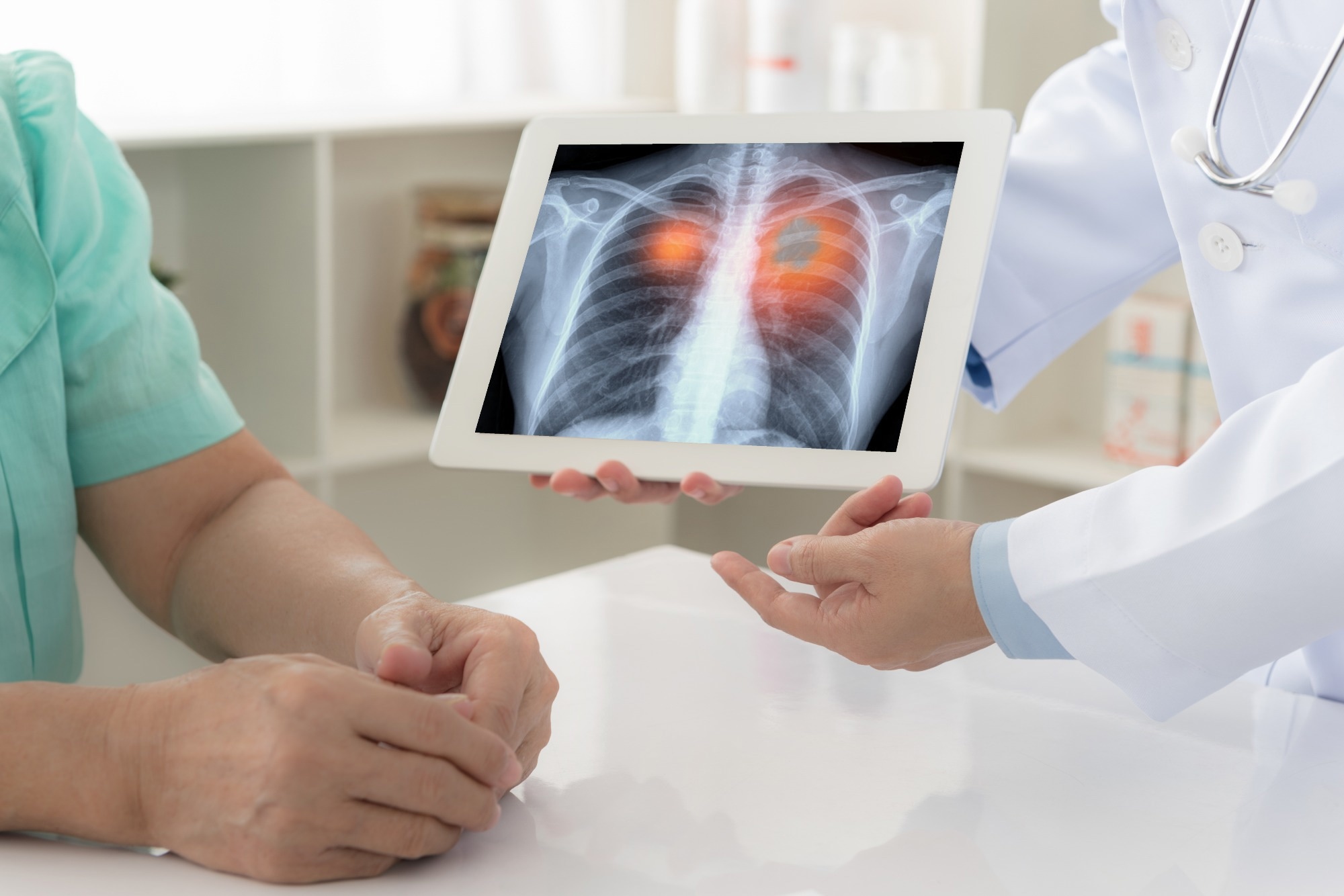 Study: Inflammation in the tumor-adjacent lung as a predictor of clinical outcome in lung adenocarcinoma. Image Credit: create jobs 51/Shutterstock.com