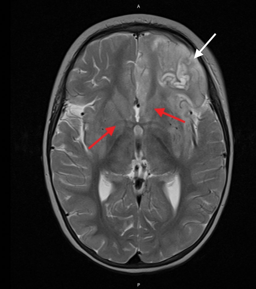 Magnetic resonance imaging of the brain of an immunocompromised child with avian paramyxovirus type 1 infection, Australia. Image, captured 16 days after hospital admission, shows predominantly left frontal and insular T2 signal hyperintensity evolving into laminar necrosis (white arrow) and hyperintensity of deep gray-matter structures (red arrows)