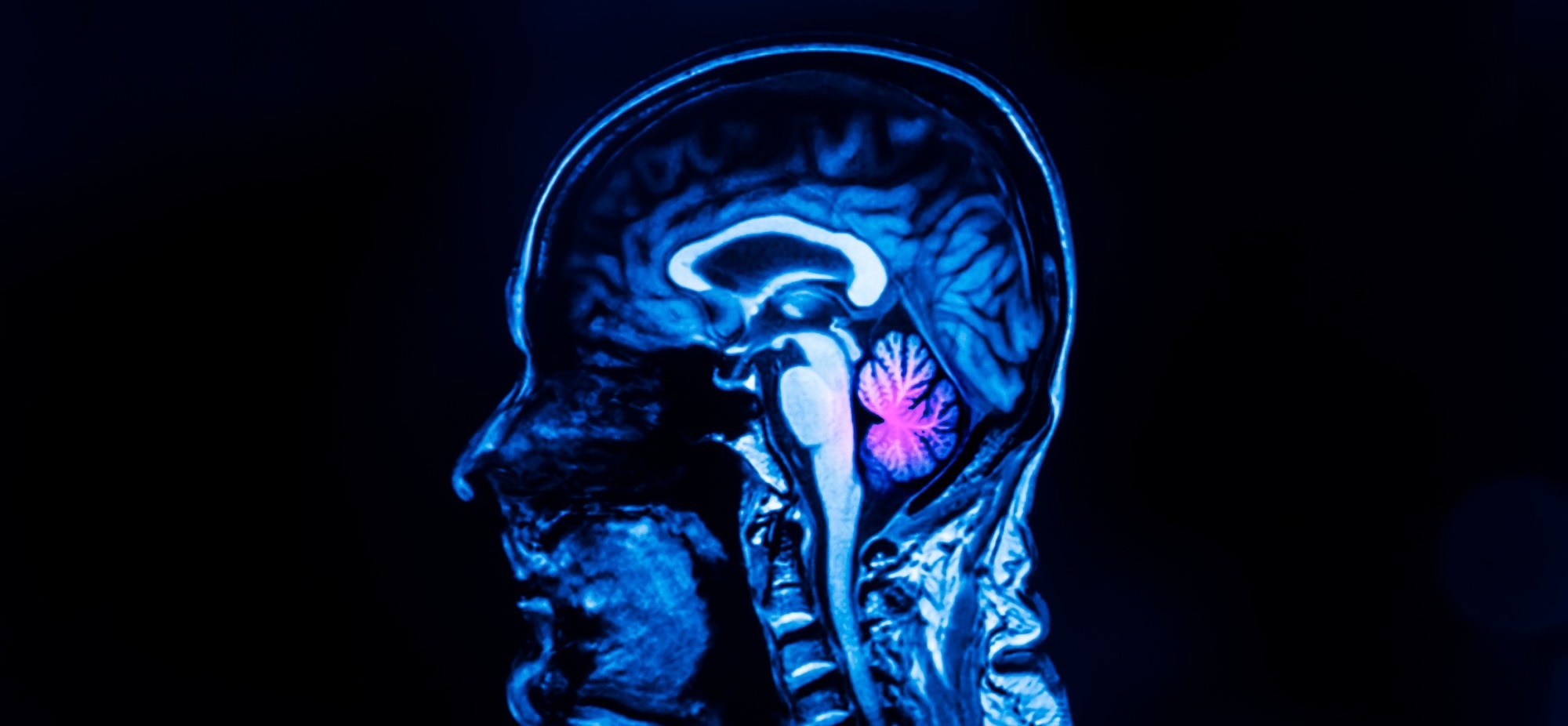 El papel del tronco encefálico en la supresión del apetito.