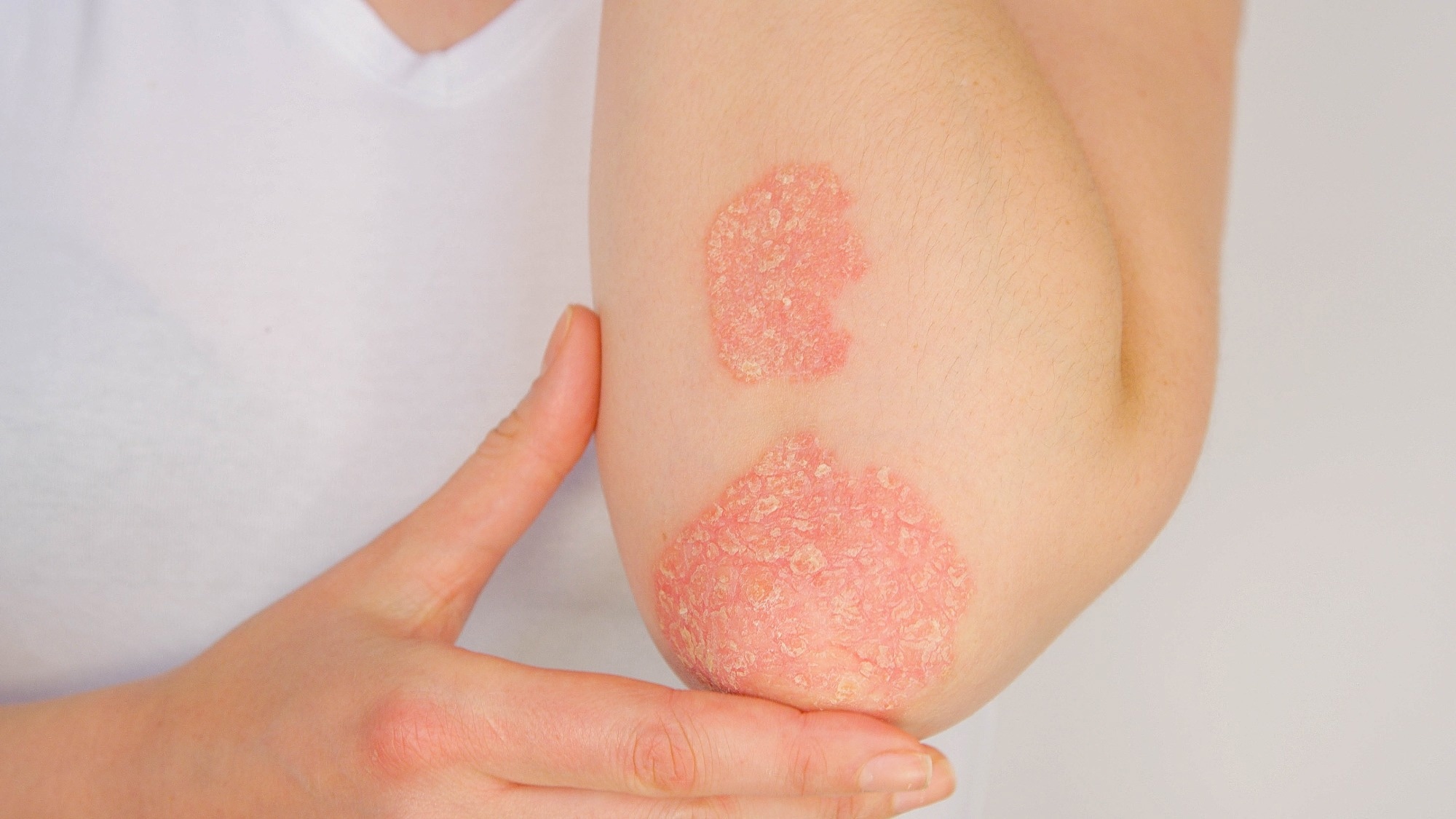 Study: Signaling pathways and targeted therapies for psoriasis. Image Credit: Flystock/Shutterstock,com