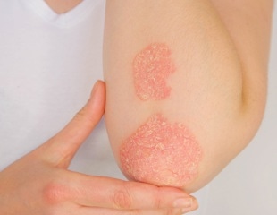 Revolutionary advances in psoriasis treatment: unveiling new therapeutic approaches