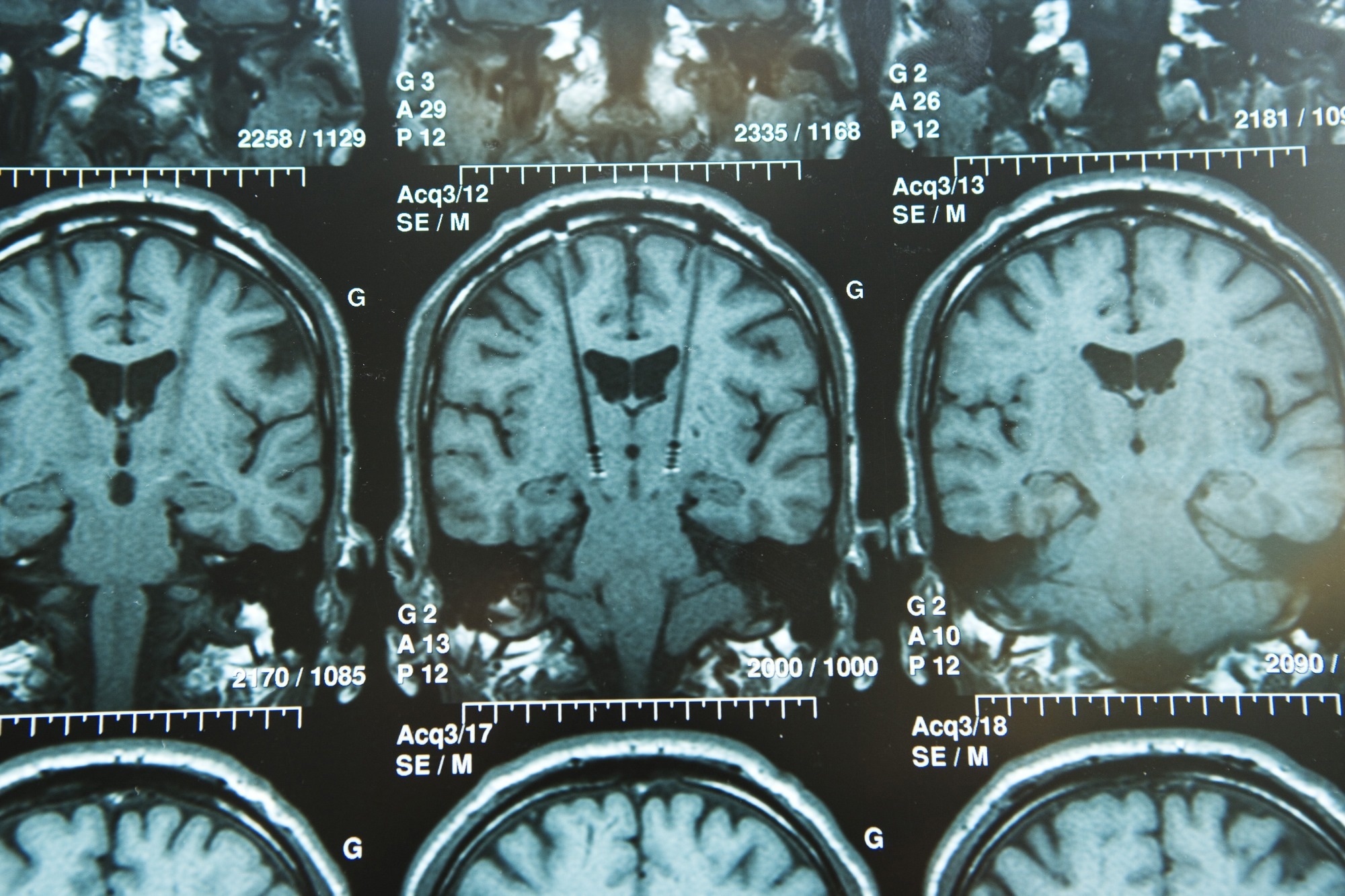 Study: Thalamic deep brain stimulation in traumatic brain injury: a phase 1, randomized feasibility study. Image Credit: Image Point Fr/Shutterstock.com