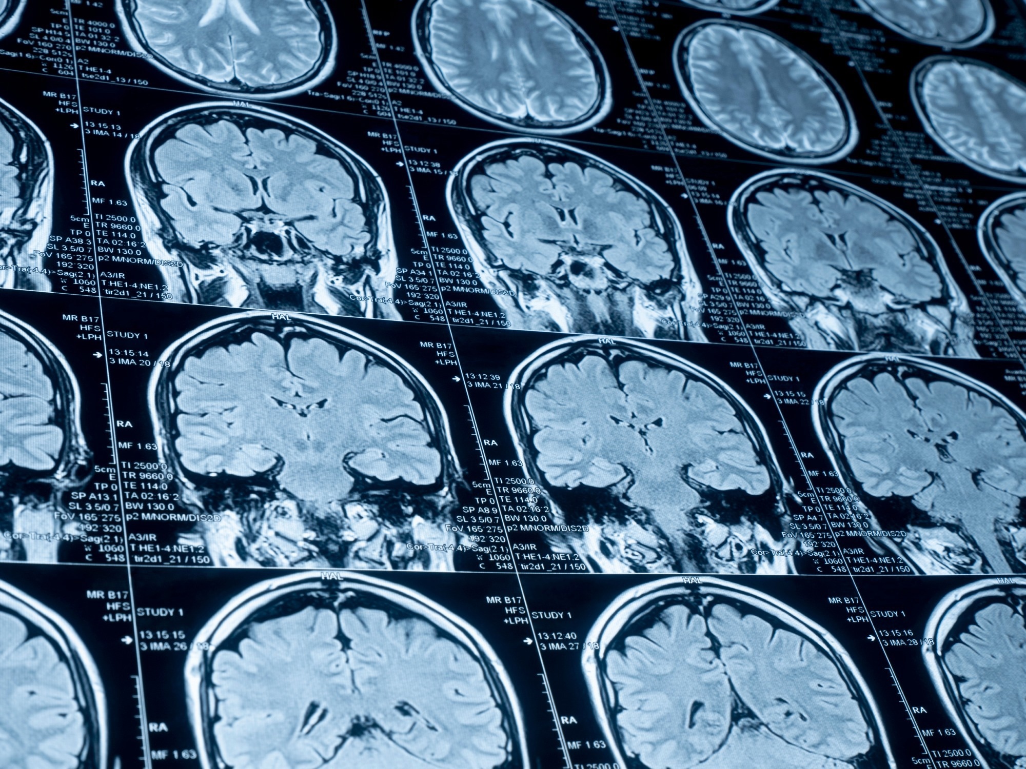 Study: Gray Matter Thickness and Subcortical Nuclear Volume in Men After SARS-CoV-2 Omicron Infection. Image Credit: ALEXSTAND / Shutterstock.com