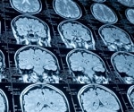 Omicron infection linked to brain structure changes in men, study finds