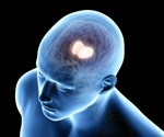 Thalamus-targeted deep brain stimulation improves cognition in brain injury patients