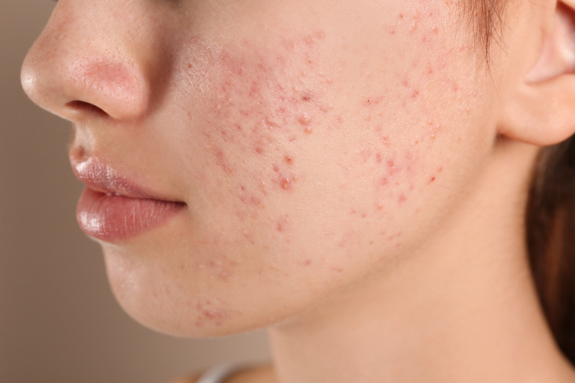Study: Evaluation of stigma toward individuals with acne. Image Credit: New Africa / Shutterstock.com