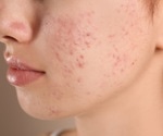 Study exposes societal stigma and misconceptions about acne