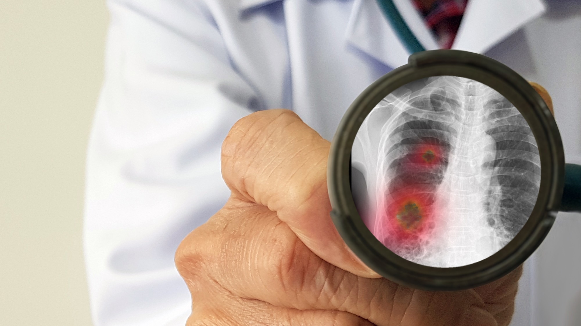 Study: Pneumococcal serotypes and risk factors in adult community-acquired pneumonia 2018–20; a multicentre UK cohort study. Image Credit: joel bubble ben/Shutterstock.com