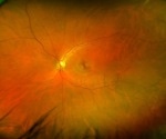 AI models using retinal images achieve perfect accuracy in diagnosing autism
