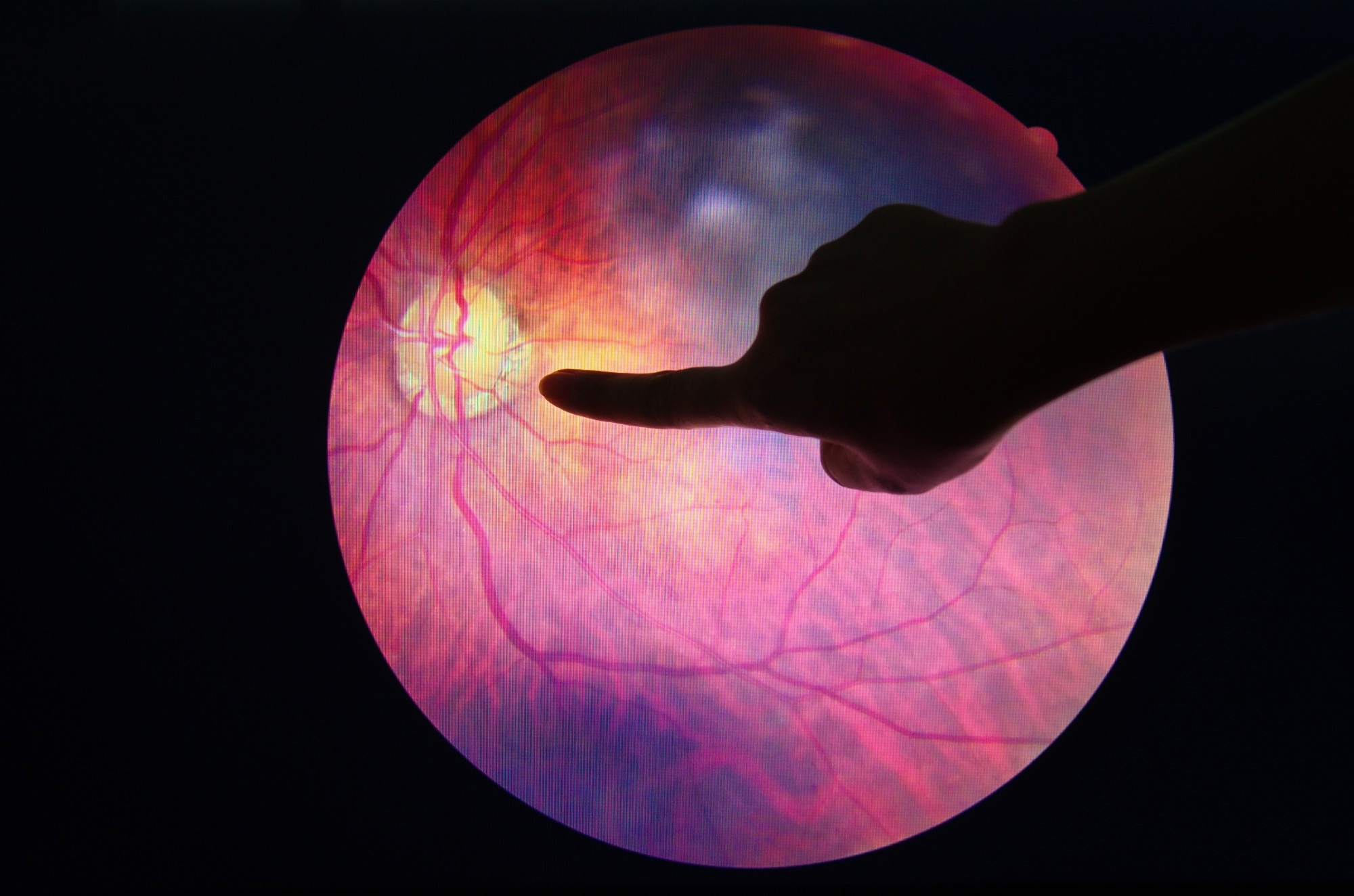 Study: A deep learning system for predicting time to progression of diabetic retinopathy. Image Credit: Anukool Manoton / Shutterstock