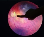 Can AI predict diabetic eye disease progression?