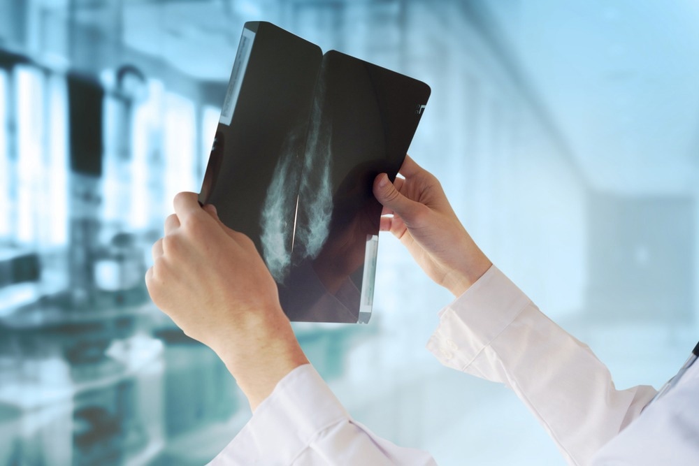 Study: Association of travel time, patient characteristics, and hospital quality with patient mobility for breast cancer surgery: A national population-based study. Image Credit: Guschenkova/Shutterstock.com