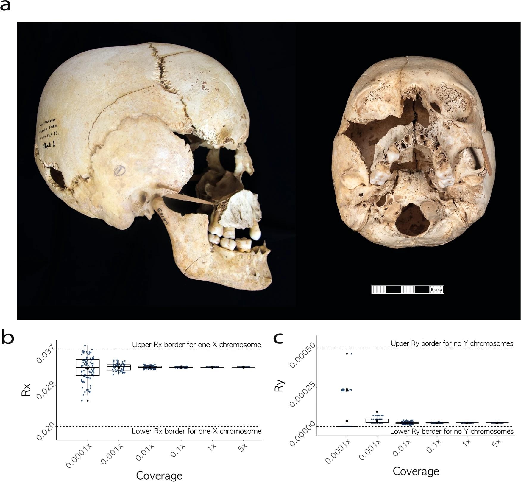 Ancient DNA reveals first prehistoric cases of Turner and Jacob's syndromes