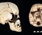 Ancient DNA reveals first prehistoric cases of Turner and Jacob's syndromes
