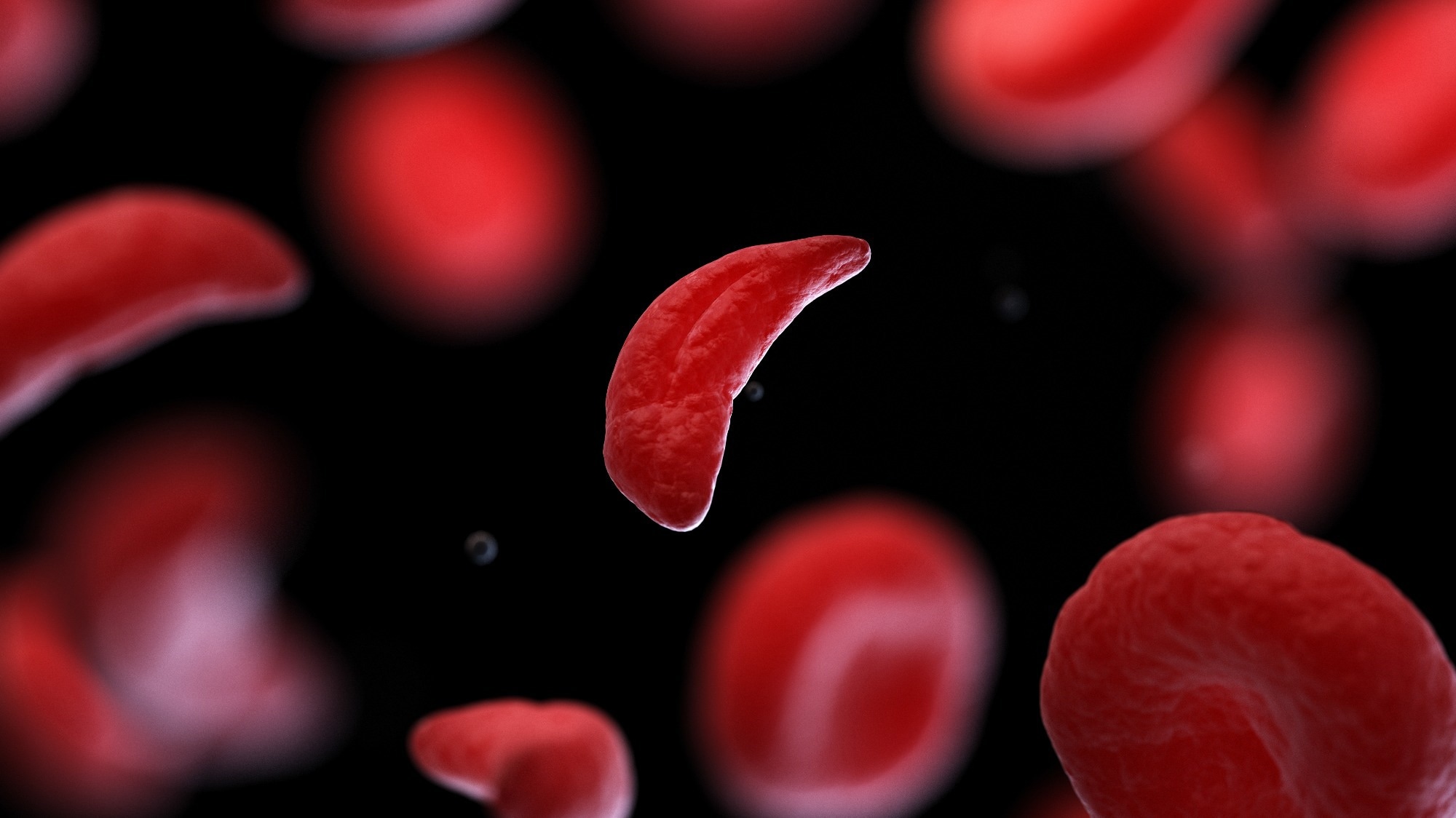 Study: Sickle Cell Disease Update: New Treatments and Challenging Nutritional Interventions. Image Credit: SciePro/Shutterstock.com