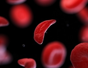 Review of traditional treatments and novel nutritional interventions for sickle cell disease
