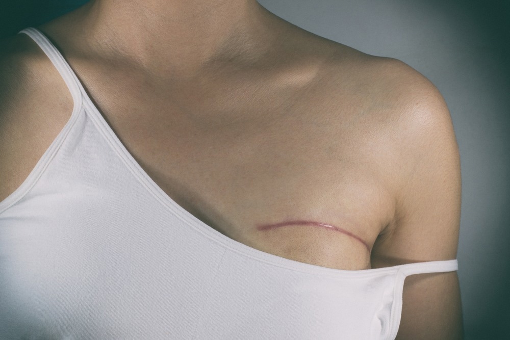 Nipple-Sparing Mastectomy  The Plastic & Reconstructive Surgery Group