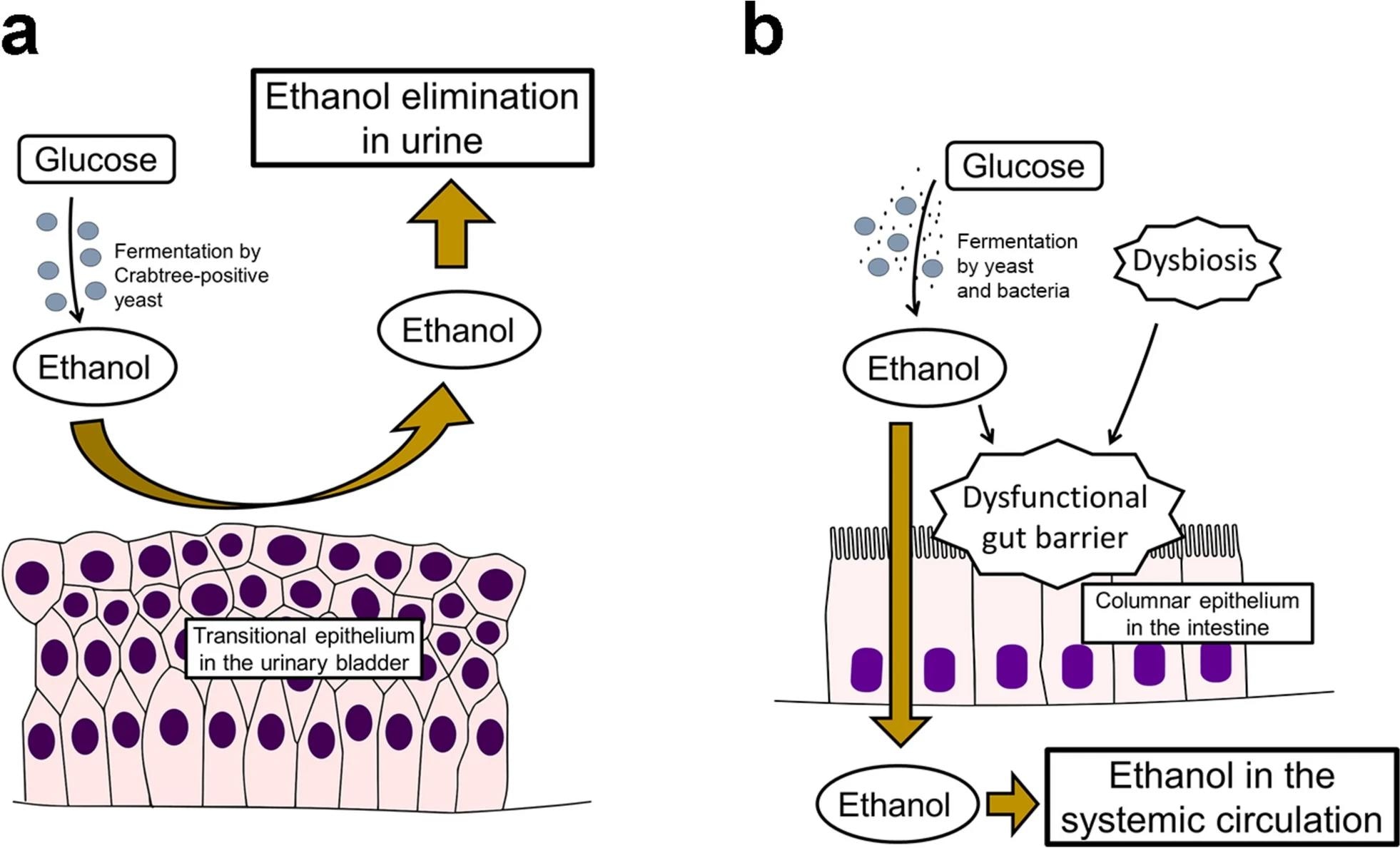 Pathophysiology of bladder fermentation syndrome and gut fermentation syndrome. a In bladder fermentation syndrome, ethanol produced through alcoholic fermentation by Crabtree-positive yeast is urinary-eliminated without getting absorbed into systemic circulation because the transitional epithelium in the urinary bladder serves as a barrier to ethanol. b In gut fermentation syndrome, ethanol produced through alcoholic fermentation by yeast and/or bacteria is absorbed into systemic circulation through the columnar epithelium in the intestine, causing alcohol intoxication. A dysfunctional gut barrier caused by dysbiosis and ethanol may also be involved in its pathogenesis