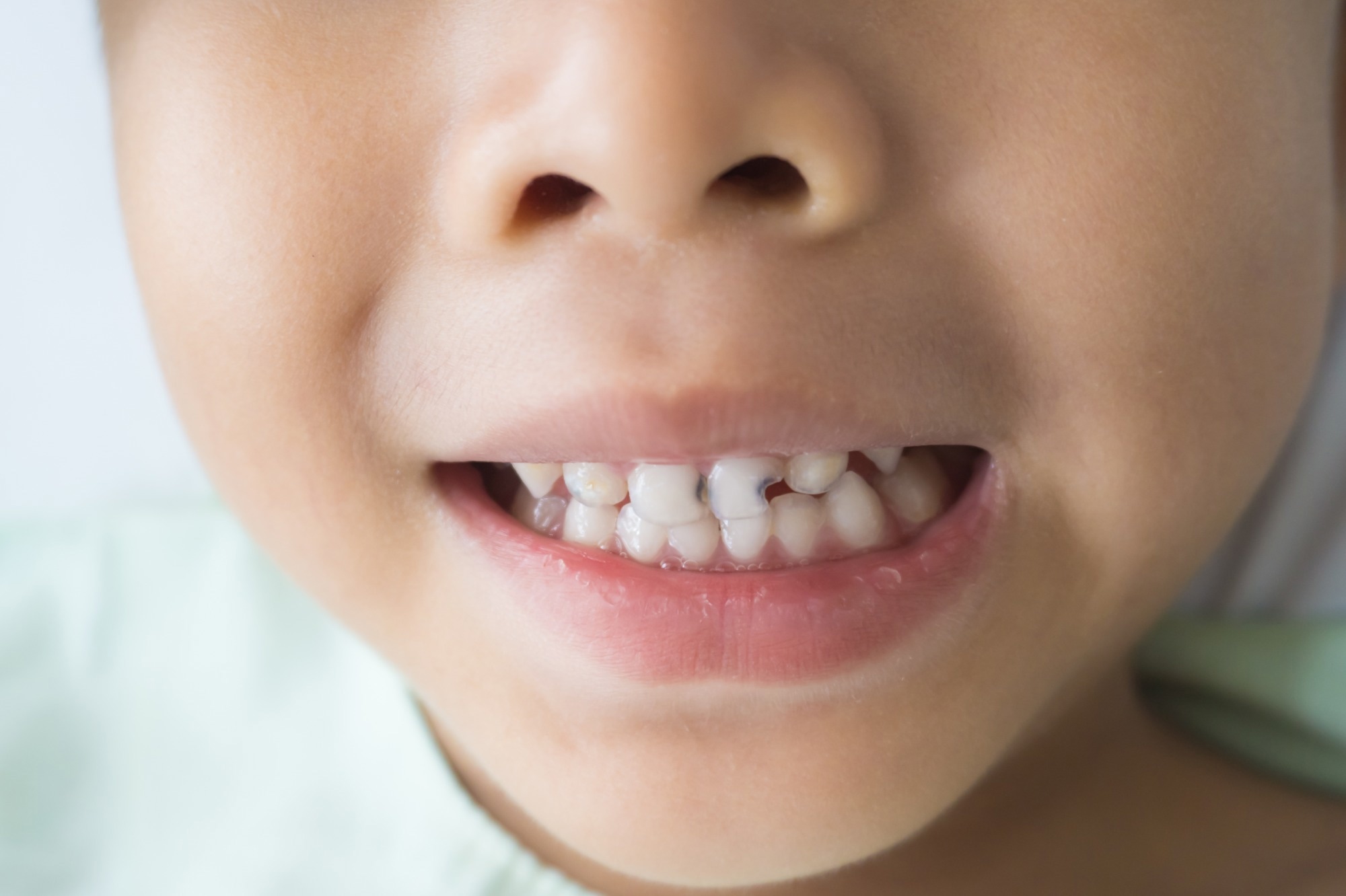 Study: The association between serum vitamin D status and dental caries or molar incisor hypomineralisation in 7–9-year-old Norwegian children: a cross-sectional study. Image Credit: modina/Shutterstock.com