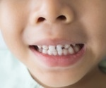 Is serum vitamin D status linked to dental caries or molar incisor hypomineralisation in children?