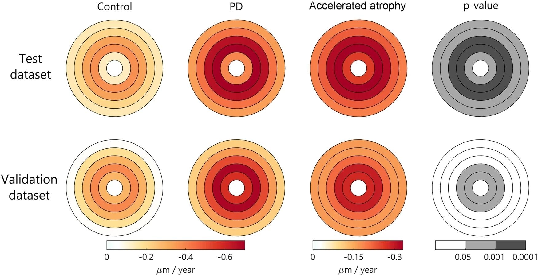 ​​​​​​​Using linear mixed-effects models adjusted for age at baseline and sex. Color represents the estimated atrophy rate in each foveo-centered area. Absolute rates are represented in the first two columns. The relative increase in PD vs. control is represented on the third column, and the corresponding significant p-values for group effect are represented in gray scale. Abbreviations: GCIPL: ganglion cell-inner plexiform layers; PD, Parkinson’s disease.