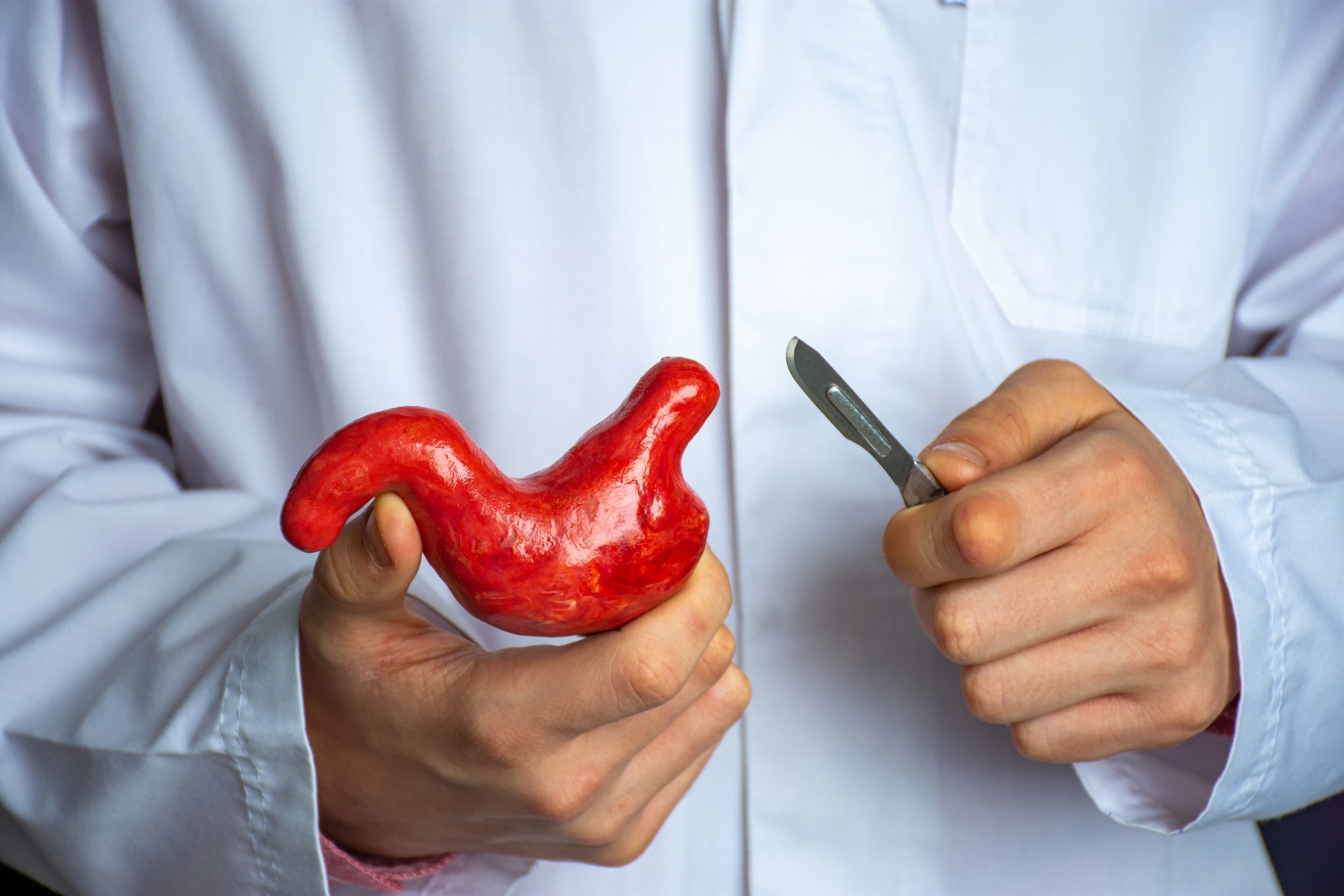 Study: Long-term effects of sleeve gastrectomy compared to Roux-en-Y gastric bypass in people with severe obesity: A multicenter, randomized, controlled phase-III trial (SleeveBypass). Image source: Shidlovski/Shutterstock.com