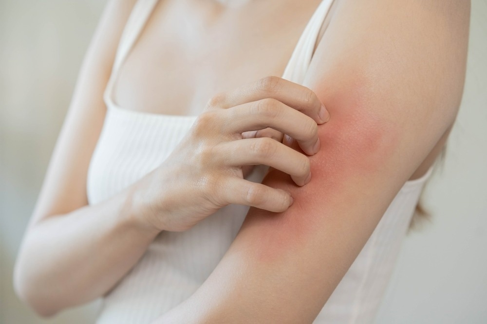 Study: Impact of climate change on atopic dermatitis: A review by the International Eczema Council. Image Credit: Kmpzzz/Shutterstock.com