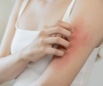The International Eczema Council investigate how climate change may impact eczema