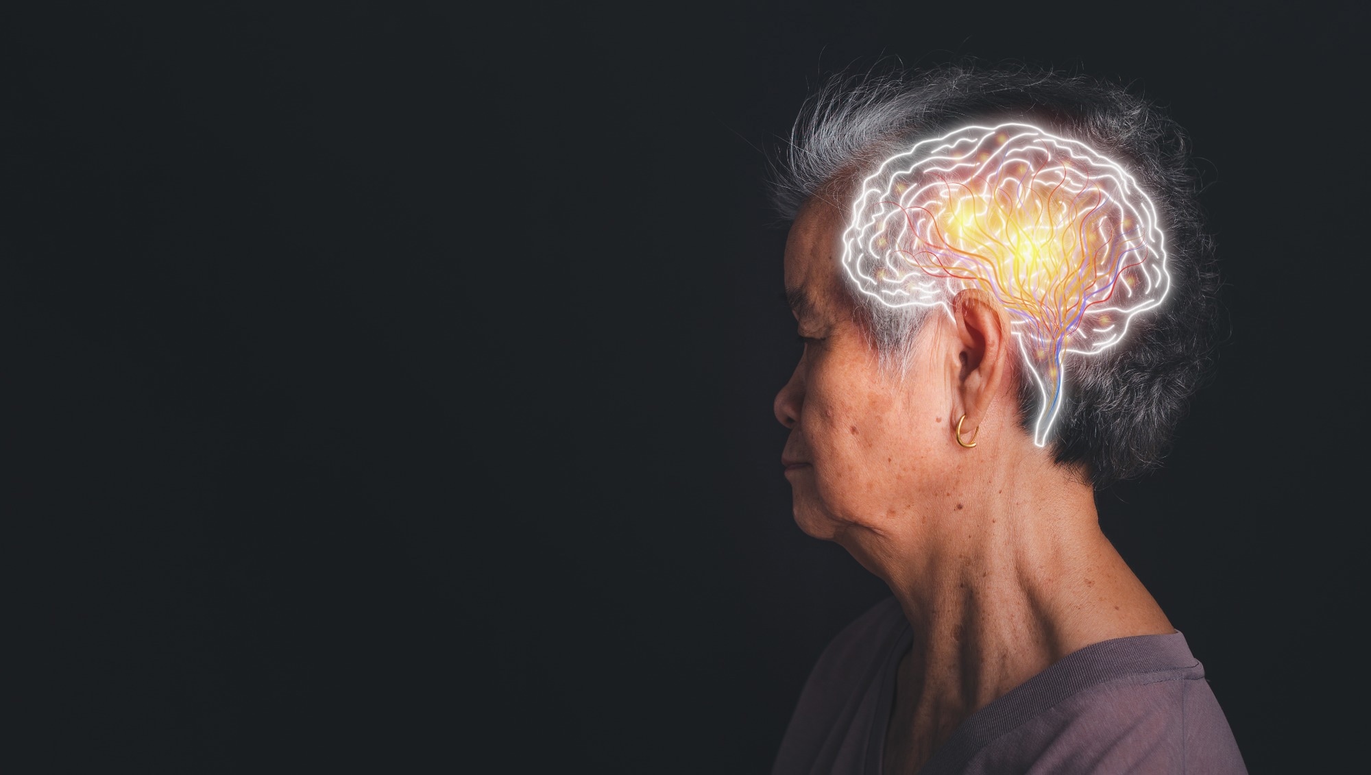 Étude : Signatures protéomiques cérébrales similaires dans la maladie d'Alzheimer et l'épilepsie.  Crédit photo : meebonstudio / Shutterstock.com