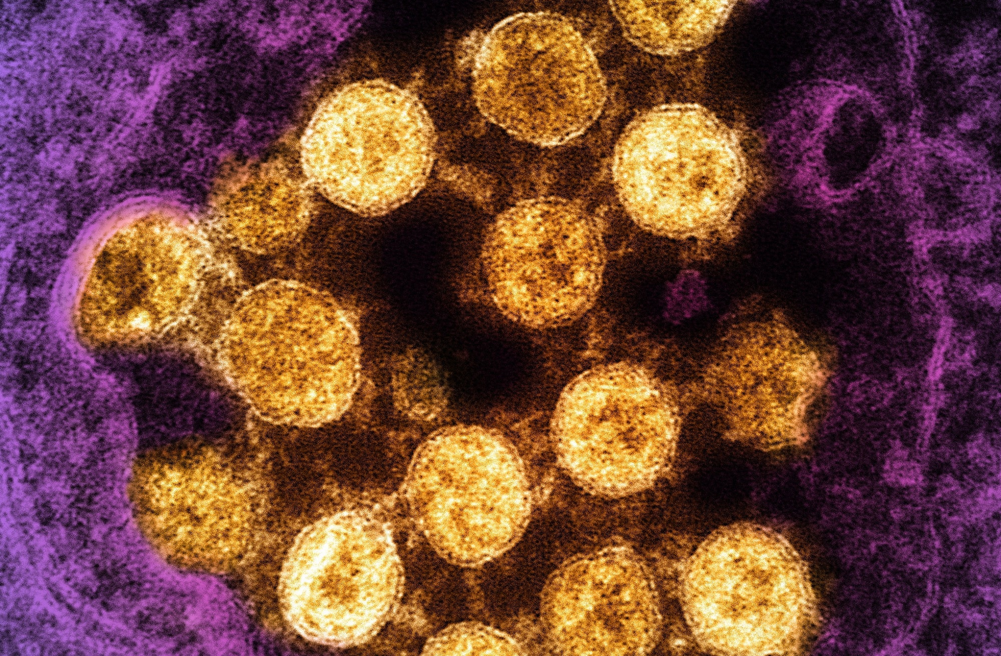 Étude : Vie virale après la mort : SARS-CoV-2 comme réservoir de peptides immunomimétiques qui se réassemblent en complexes supramoléculaires pro-inflammatoires.  Source de l'image : NIAID