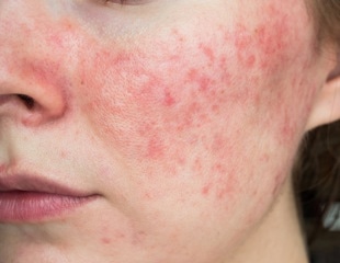 What natural compounds can help you manage your rosacea?