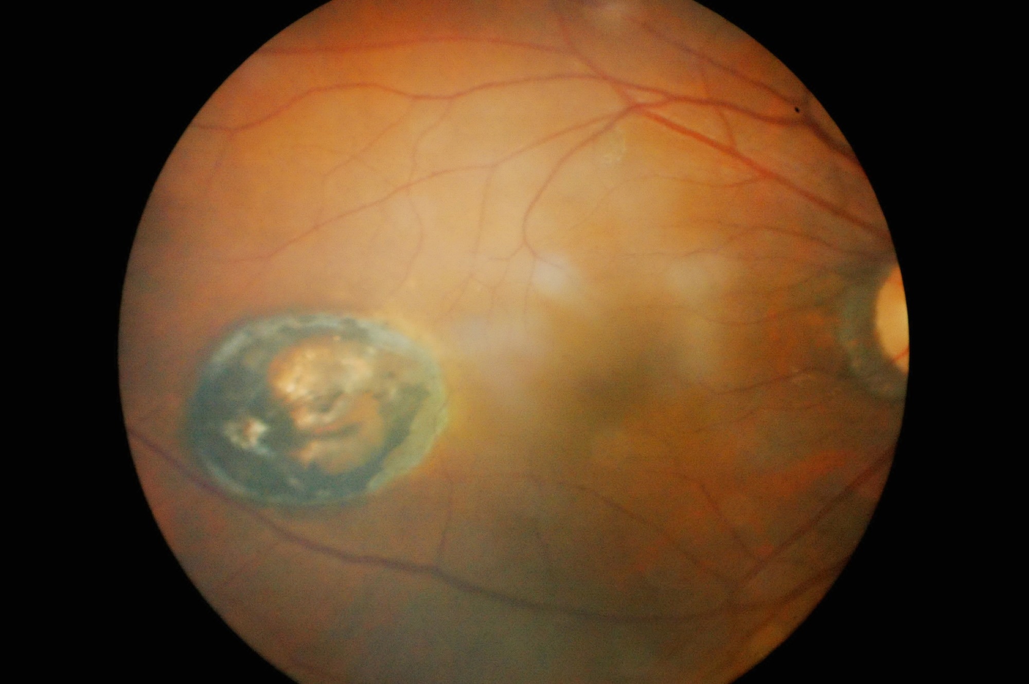 Study: Therapeutic Targeting of Cellular Senescence in Diabetic Macular Edema: Results of Preclinical and Phase 1 Trials.  Image credit: Anukool Manoton/Shutterstock