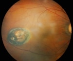 New treatment targeting aging cells could offer lasting relief for diabetic macular edema