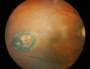 New treatment targeting aging cells could offer lasting relief for diabetic macular edema