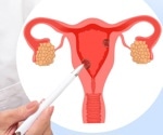 Genetics of estrogen production linked to endometrial cancer risk in postmenopausal women