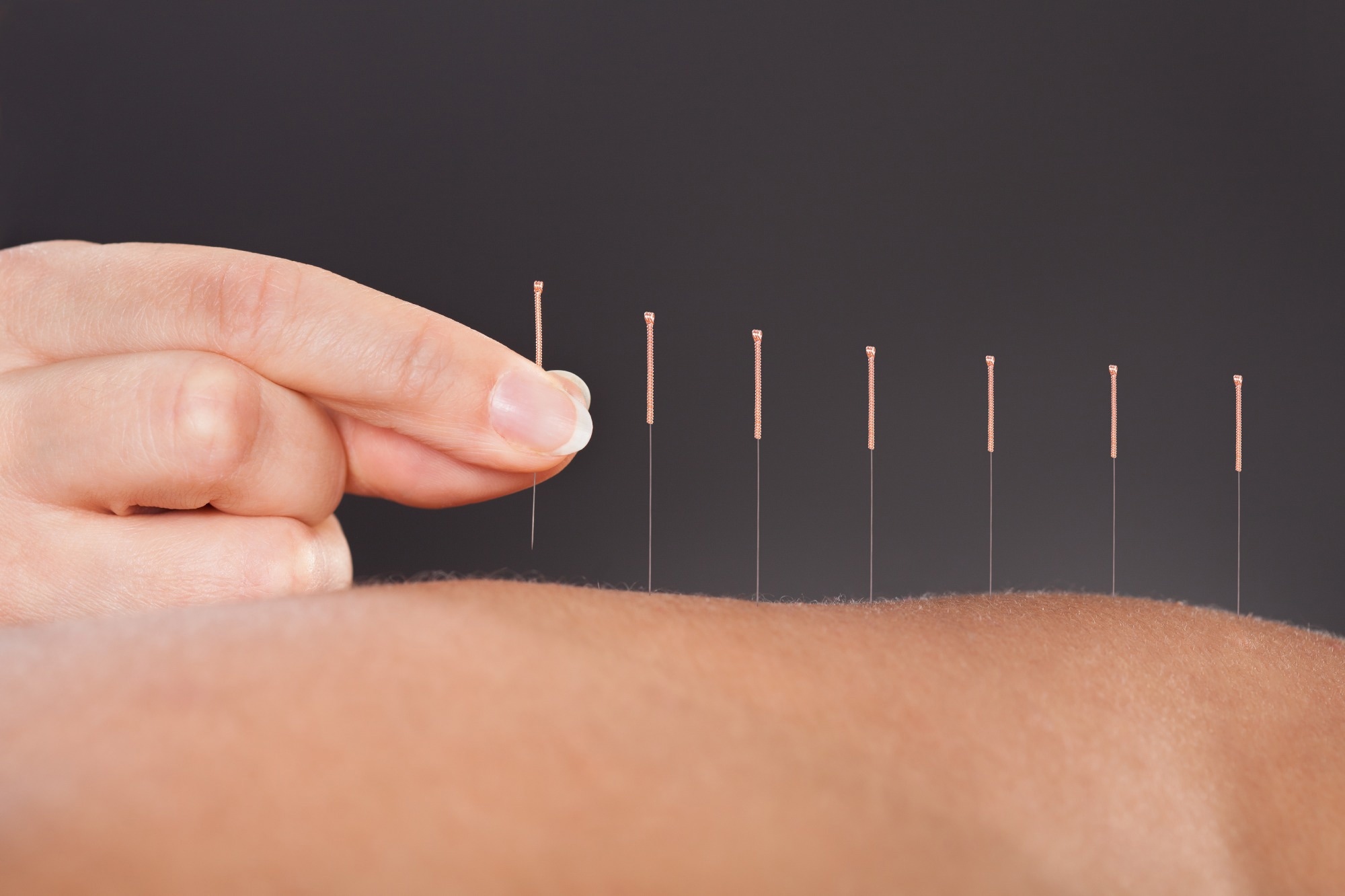 Study: Effect of acupuncture on ischaemic stroke in patients with rheumatoid arthritis: a nationwide propensity scorematched study. Image Credit: Andrey_Popov/Shutterstock.com