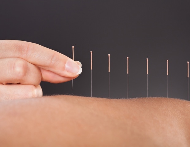 Acupuncture is beneficial in reducing the incidence of ischaemic stroke