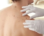 Advanced melanoma survival rates improve significantly from 2013 to 2019, Dutch study finds